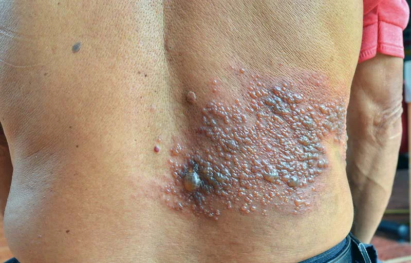 herpes-zoster6
